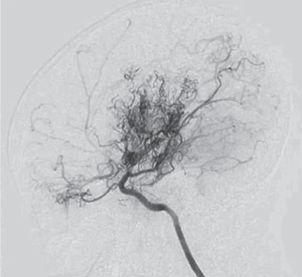Cerebral angiogram (DSA) showing the dense ‘puff of smoke’ network of collateral vessels typical of Moyamoya angiopathy