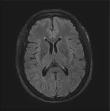 MRI scan of the brain