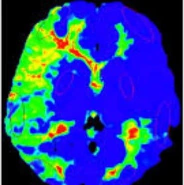 MR Perfusion imaging